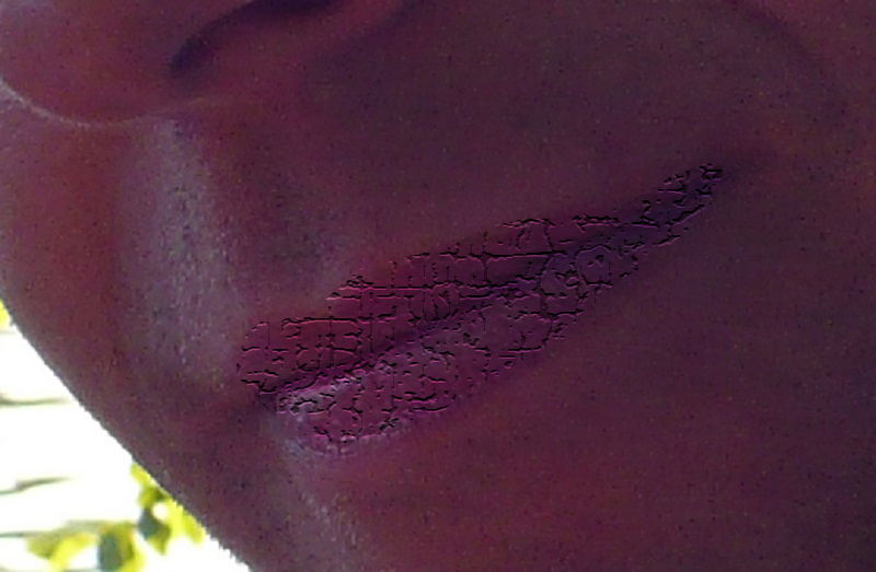 Lippenrisse